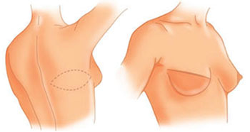 Reconstruction mammaire par lambeau de grand dorsal à Tours