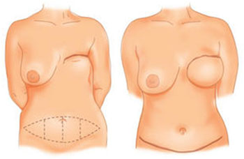 Reconstruction mammaire par lambeau de grand droit de l'abdomen à Tours