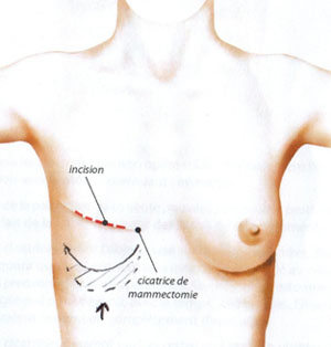 Reconstruction mammaire par prothèse à Tours